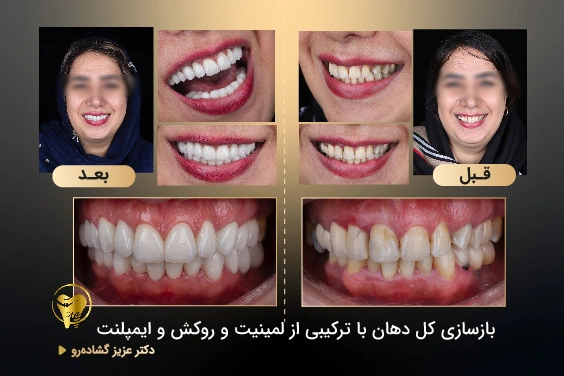 هزینه لمینت سرامیکی دندان در تهران چقدر است؟